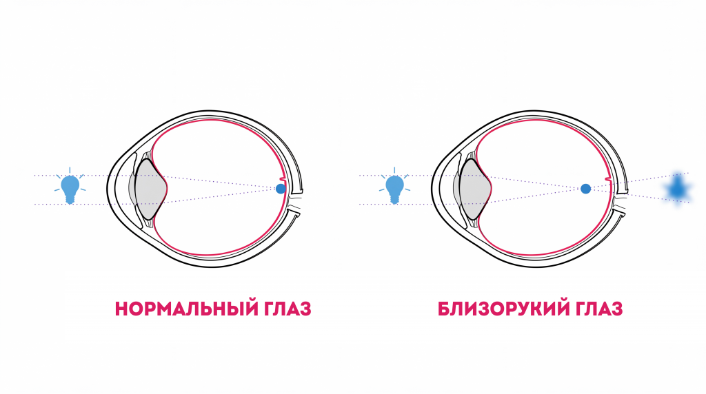 Схема нормального глаза и близорукого глаза