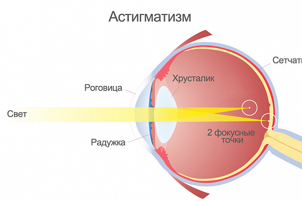 Что такое астигматизм?